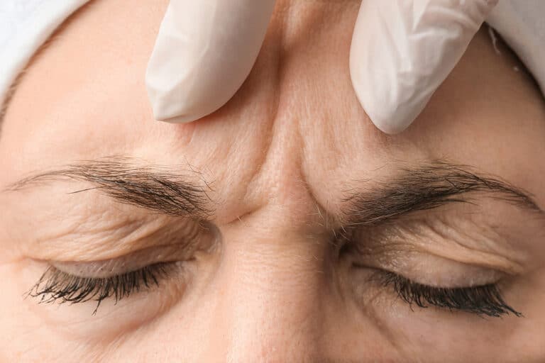 female-forehead-with-wrinkles-2025-02-10-10-46-44-utc
