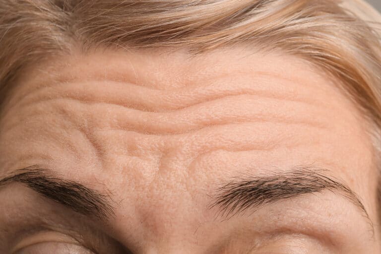 female-forehead-with-wrinkles-2025-02-10-13-24-12-utc
